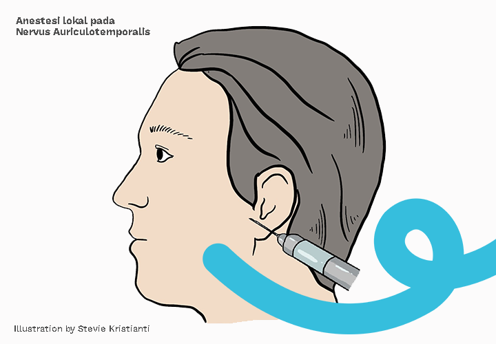 Anestesi Lokal Reduksi TMJ